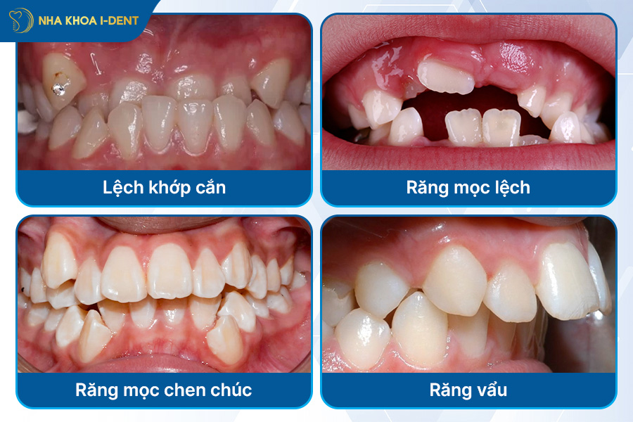 niềng răng mắc cài kim loại