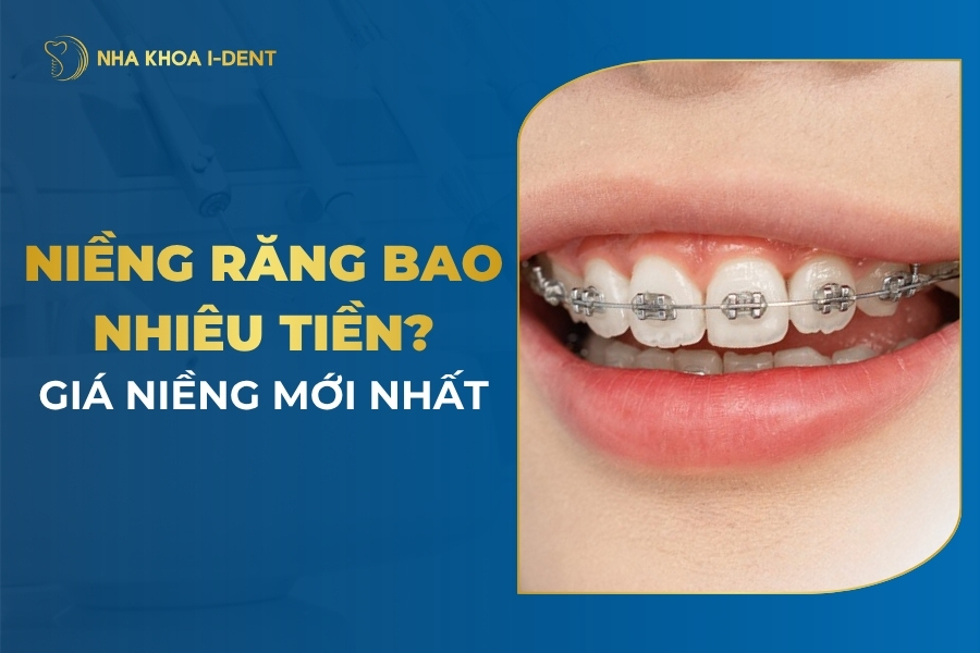 Niềng Răng Giá Bao Nhiêu? Giá Niềng Mới Nhất [Tháng 5/2026]