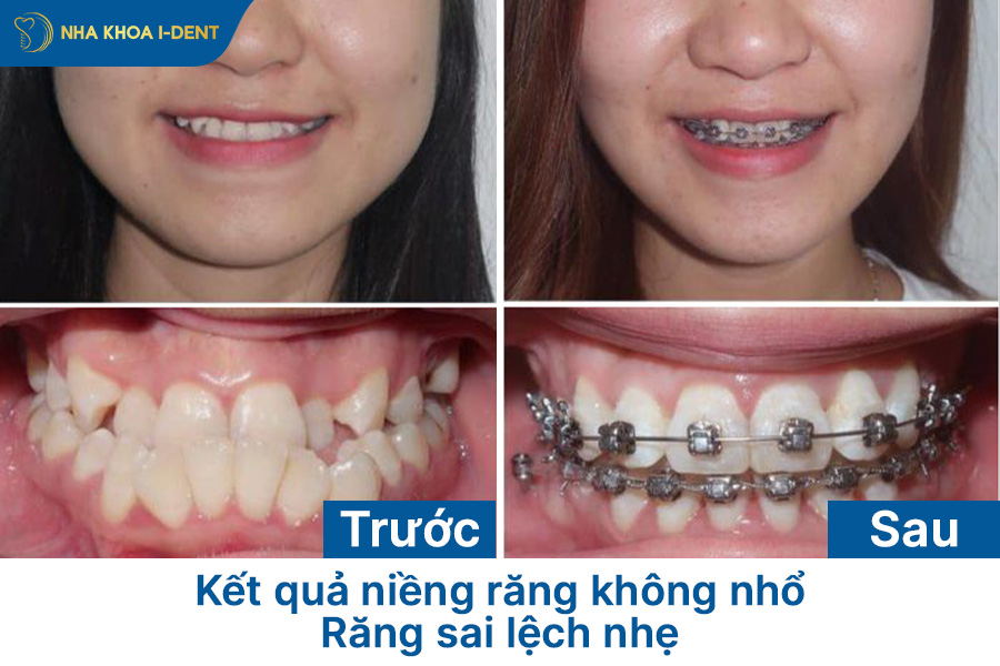 niềng răng có cần nhổ răng không