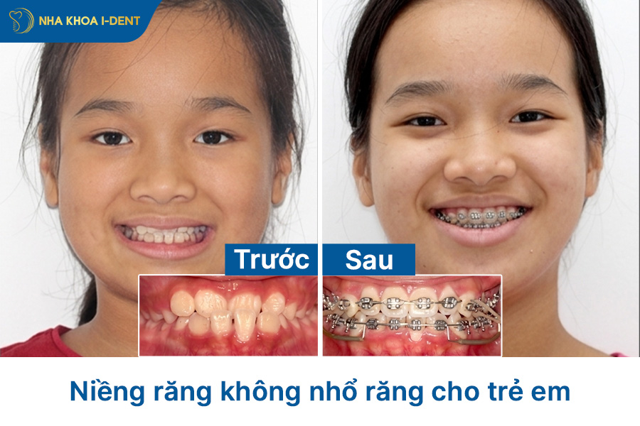 niềng răng có nhổ răng không