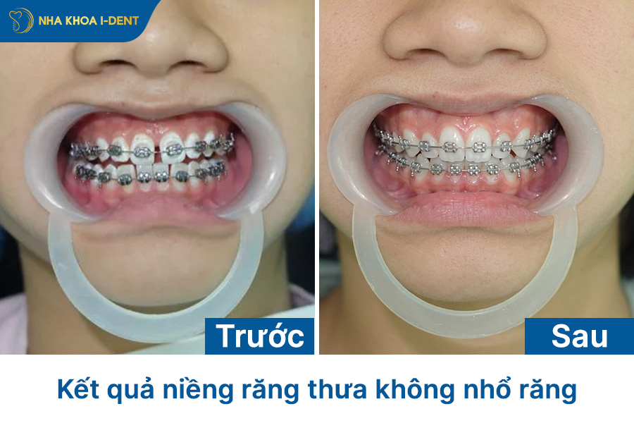 niềng răng có phải nhổ răng không