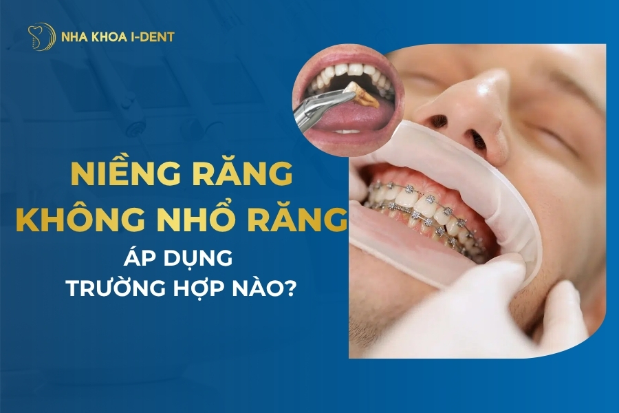 Niềng răng không nhổ răng được áp dụng cho trường hợp nào?