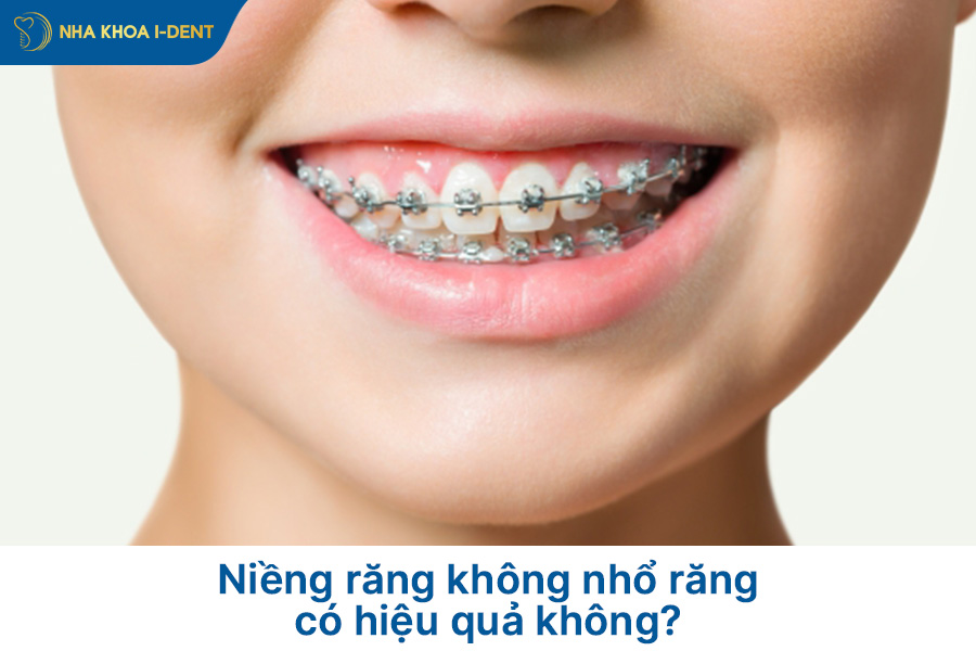 niềng răng không nhổ răng có hiệu quả không