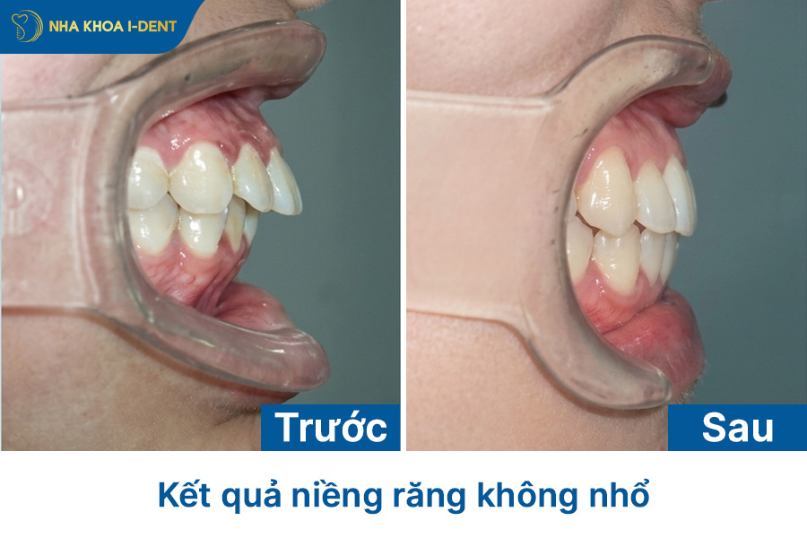 niềng răng không nhổ