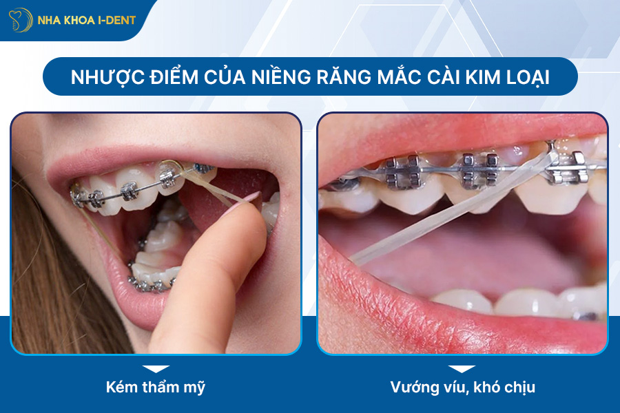 niềng răng mắc cài kim loại là gì