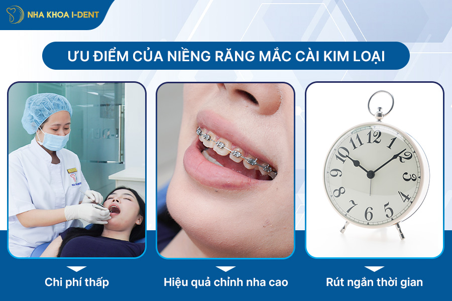 niềng răng mắc cài kim loại