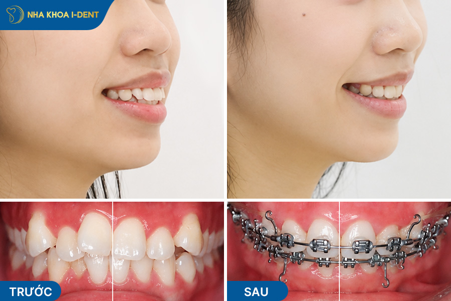niềng răng truyền thống