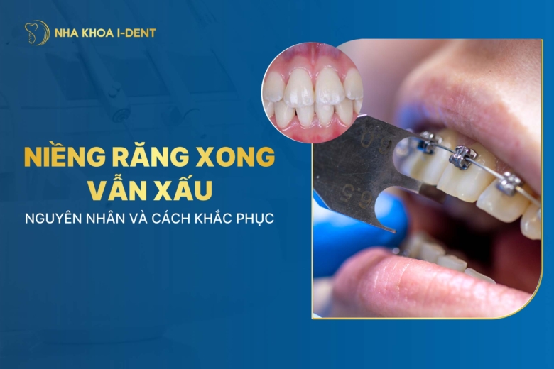 Niềng răng xong vẫn xấu? Nguyên nhân và cách khắc phục