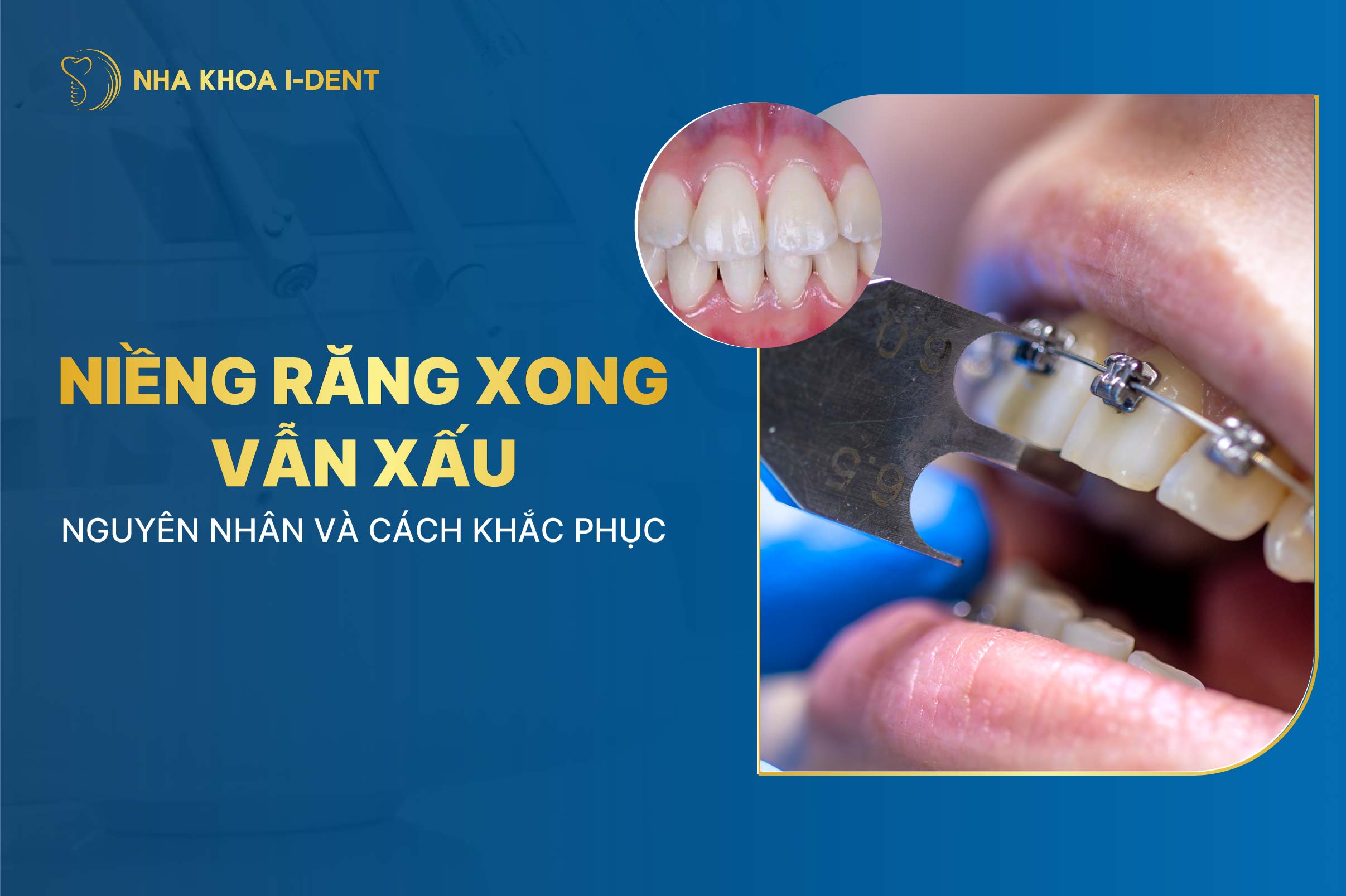 Niềng răng xong vẫn xấu? Nguyên nhân và cách khắc phục