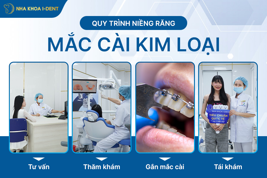 quy trình niềng răng mắc cài kim loại