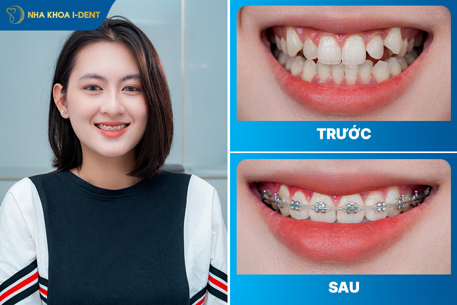 răng hạt ngô