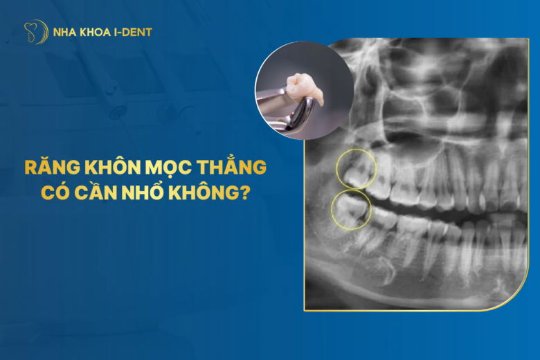 Răng khôn mọc thẳng có nên nhổ không? Nguy hiểm không?