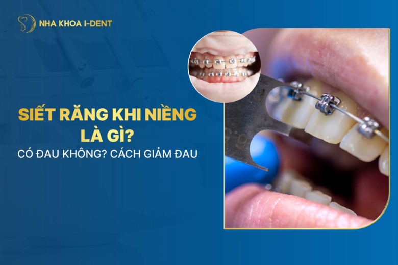 Siết răng khi niềng là gì? Đau không? Cách giảm đau
