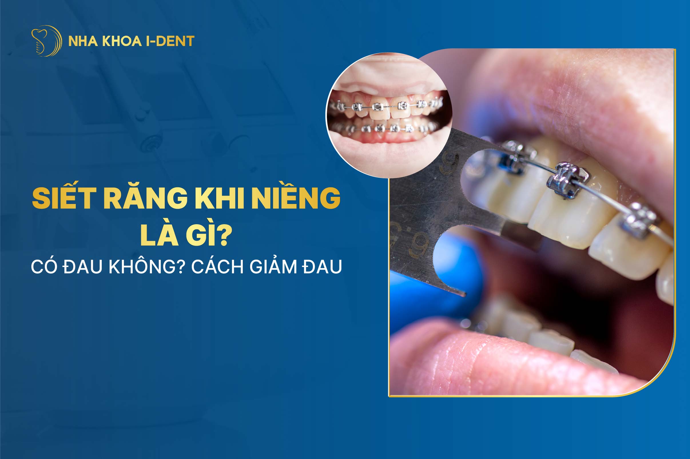 Siết răng khi niềng là gì? Đau không? Cách giảm đau