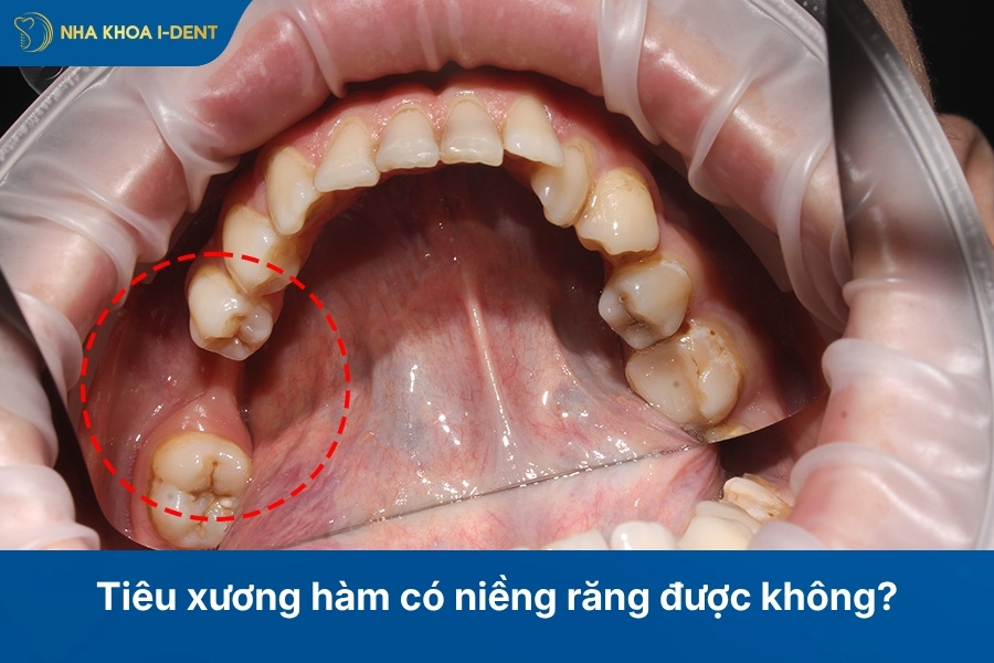 Tiêu xương hàm có niềng răng được không