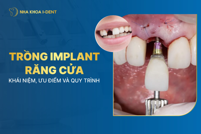 Trồng Implant răng cửa: Quy trình thực hiện và chi phí
