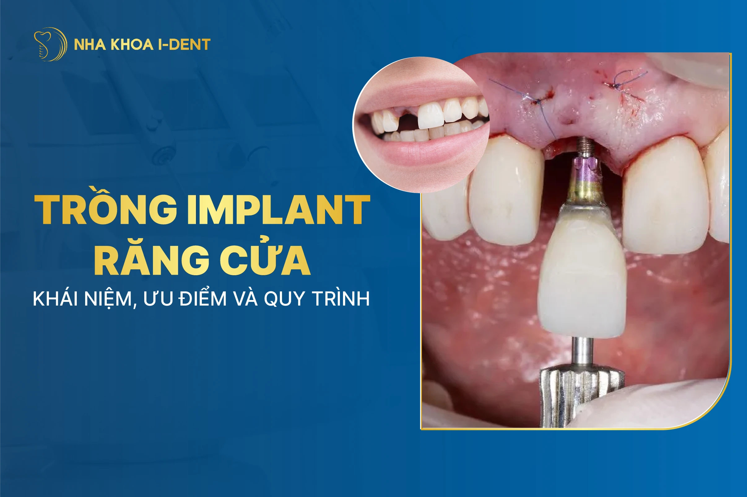 Trồng Implant răng cửa: Quy trình thực hiện và chi phí