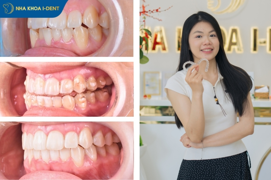 bị hô hàm trên có niềng răng được không