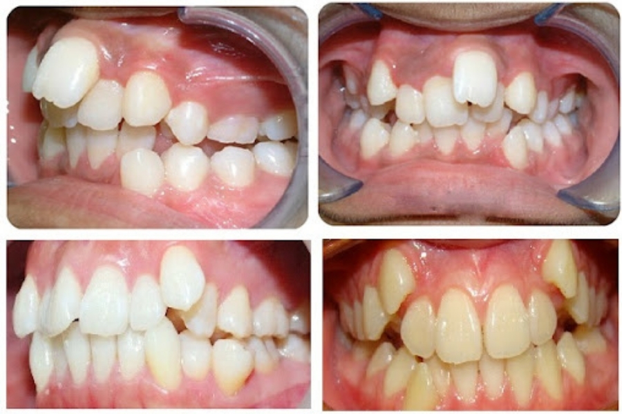 chỉnh răng mọc lệch không cần niềng