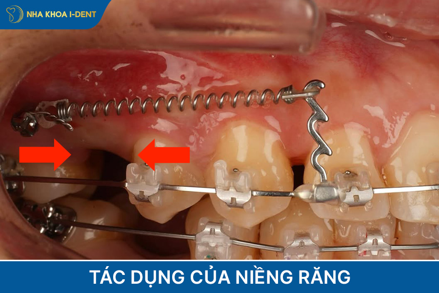 công dụng của niềng răng
