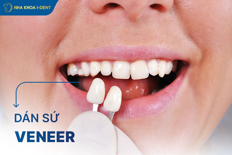 dán sứ veneer