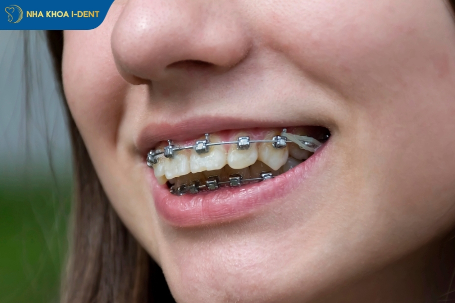 hô hàm có niềng răng được không