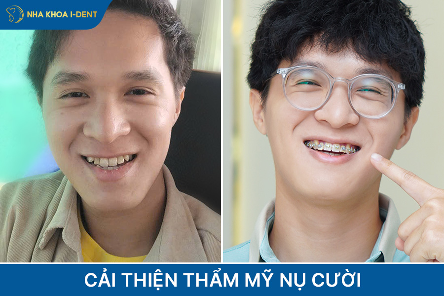 lợi ích của việc niềng răng