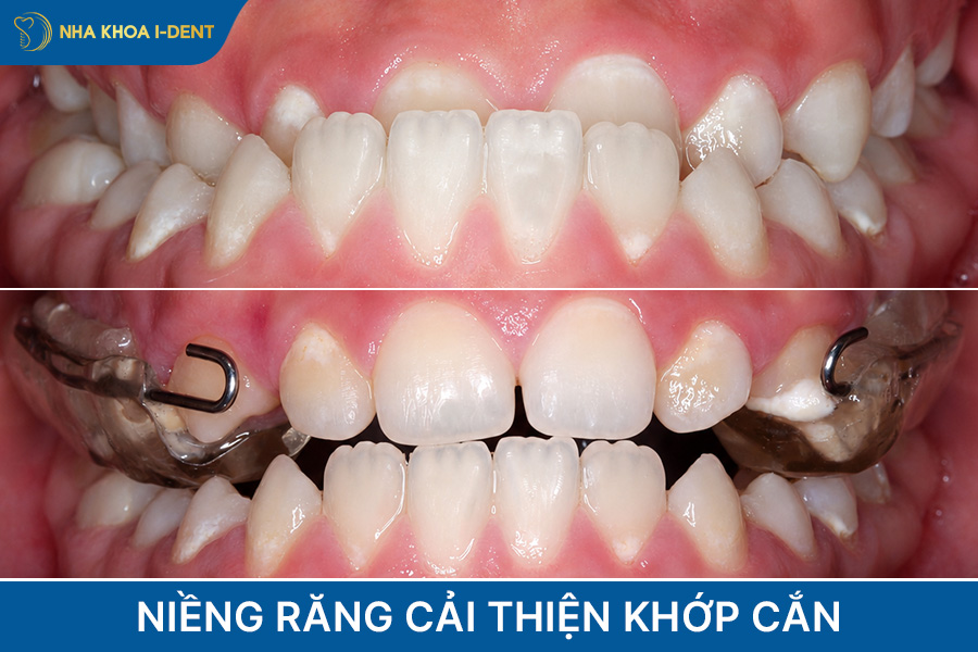 lợi ích khi niềng răng