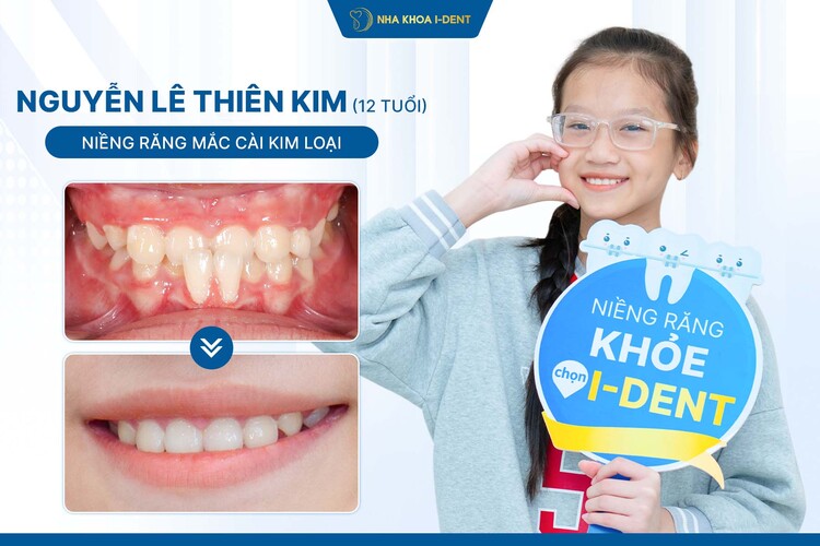 HÀNH TRÌNH NIỀNG RĂNG CỦA KHÁCH HÀNG THIÊN KIM: KHẮC PHỤC KHỚP CẮN NGƯỢC Ở ĐỘ TUỔI VÀNG