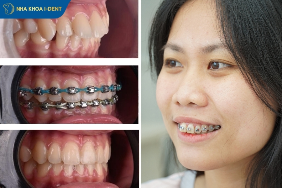 niềng răng chỉnh hàm hô