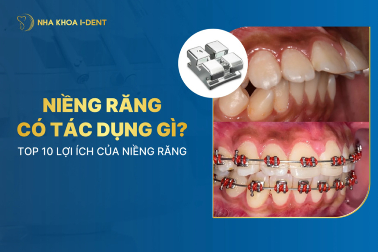 Top 10 lợi ích của việc niềng răng mà bạn nên biết