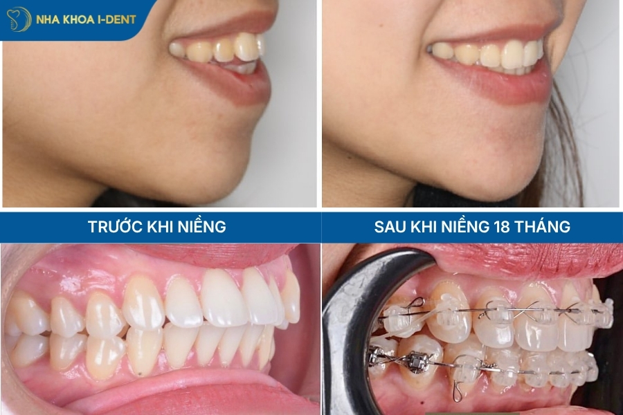 hô hàm có niềng được không