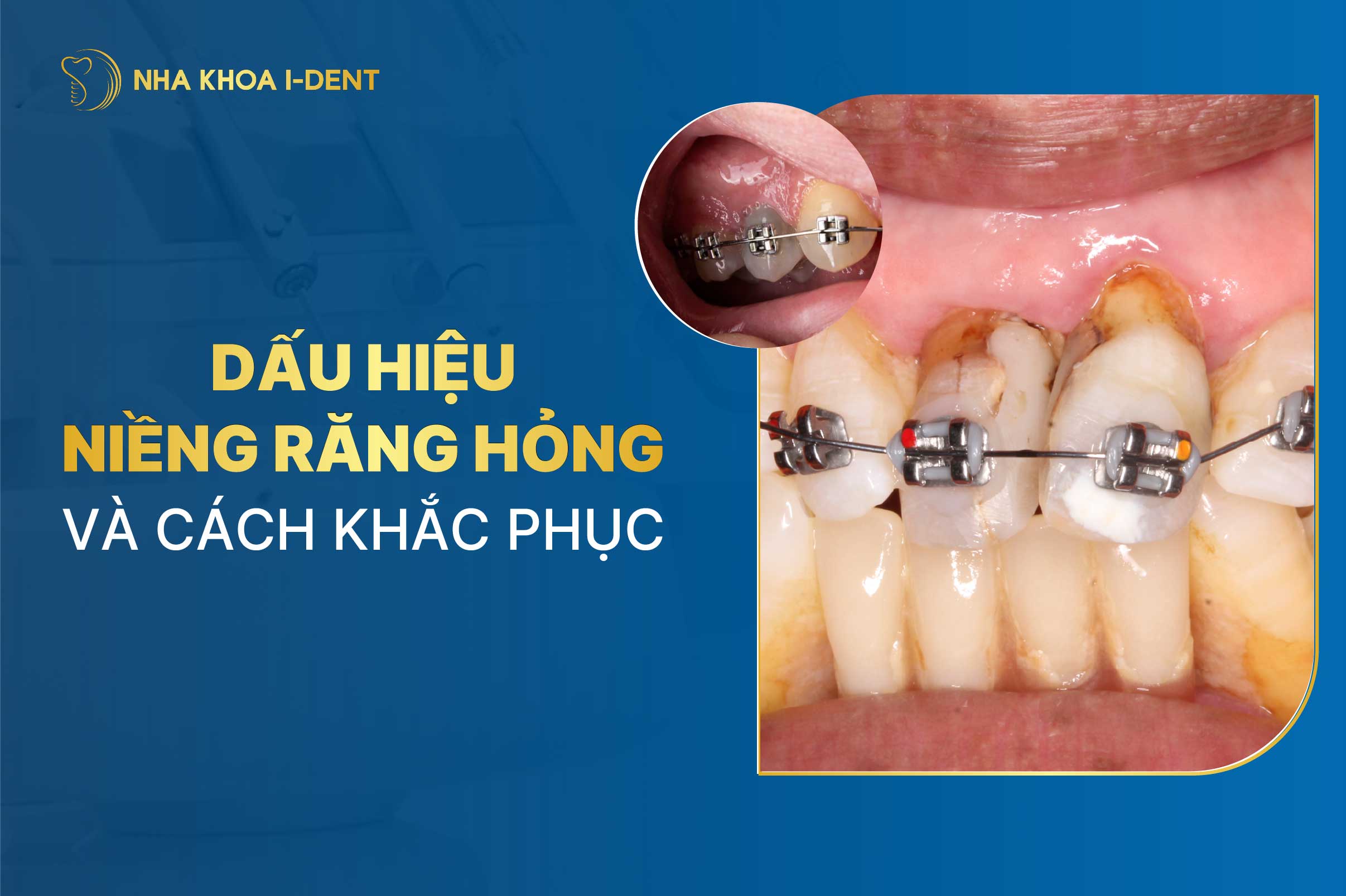 Niềng Răng Hỏng: Dấu Hiệu Nhận Biết Và Khắc Phục
