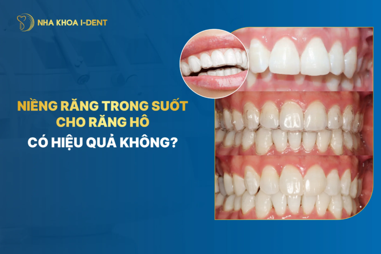 Niềng răng trong suốt cho răng hô có nên không?