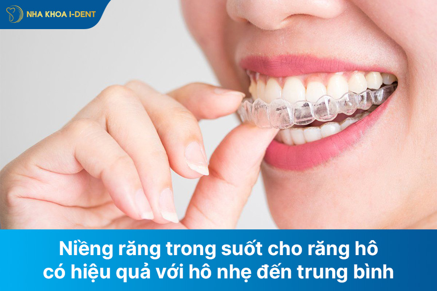 niềng răng trong suốt cho răng hô