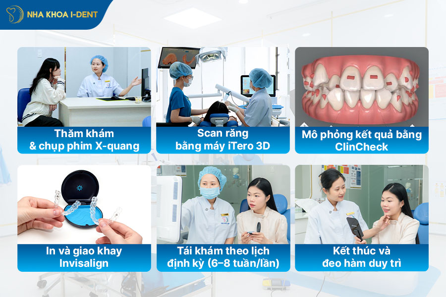 niềng răng trong suốt cho răng hô