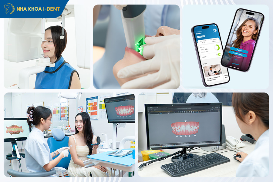 giá niềng răng trong suốt bao nhiêu tiền