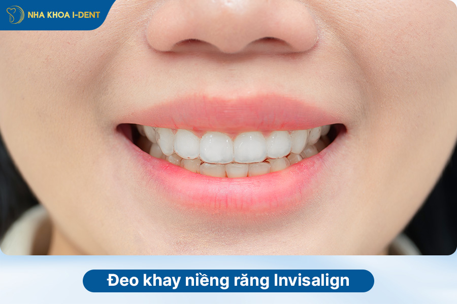 quy trình niềng răng trong suốt