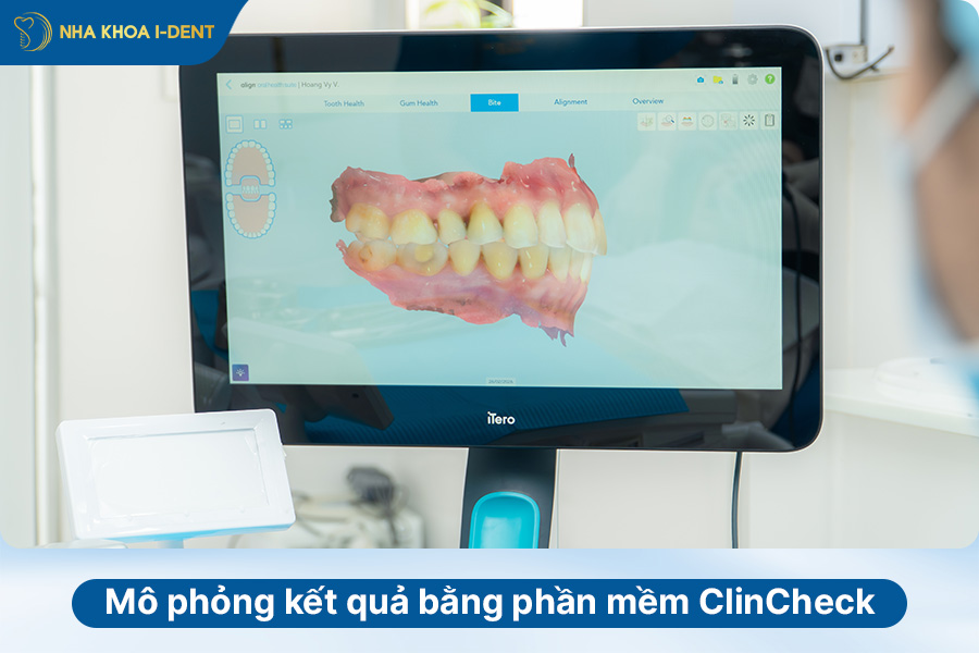 quy trình niềng răng invisalign