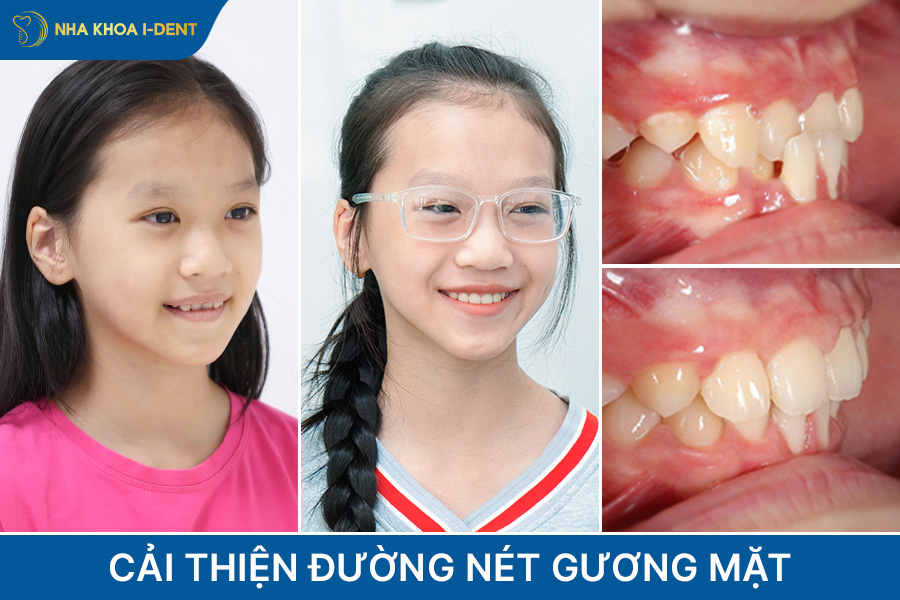 tại sao nên niềng răng