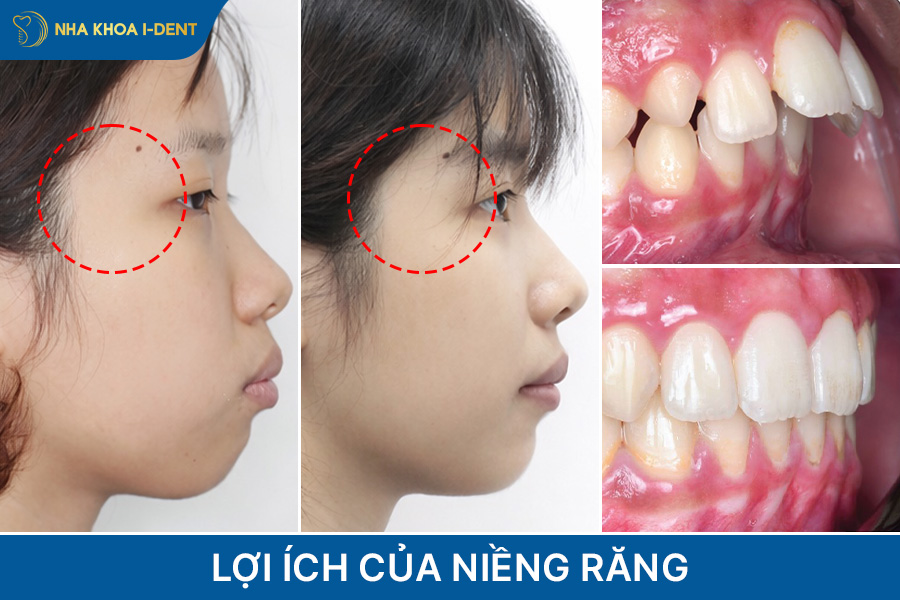 tại sao phải niềng răng