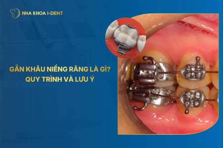 Quy trình gắn khâu niềng răng là gì? Có đau không?