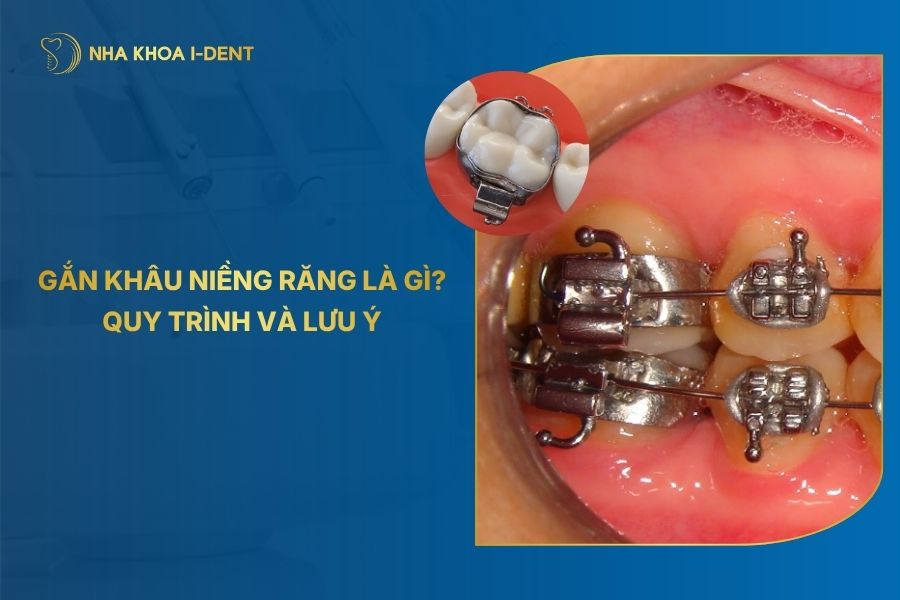 Quy trình gắn khâu niềng răng là gì? Có đau không?