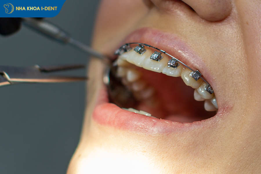 cố định răng trước khi tháo niềng