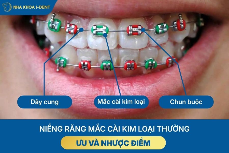 các loại mắc cài