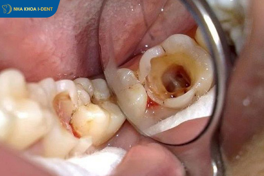 các tác hại nếu không nhổ răng sâu