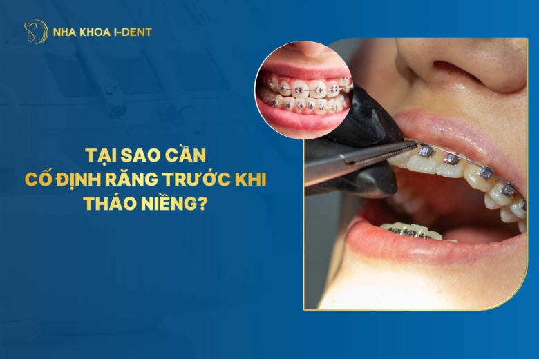 [Giải đáp] Tại sao cần cố định răng trước khi tháo niềng?