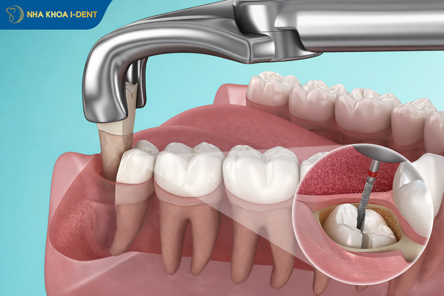 có nên nhổ răng số 8