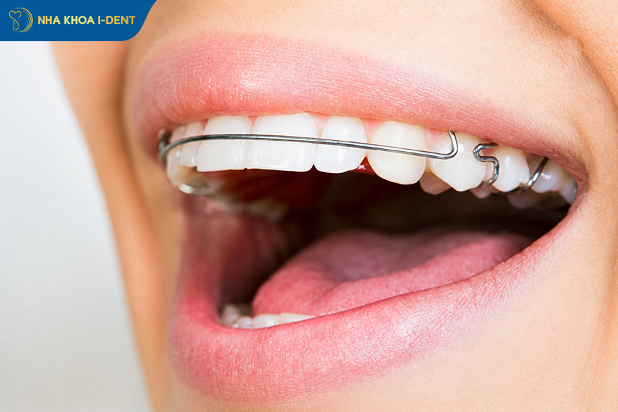niềng răng có được vĩnh viễn không