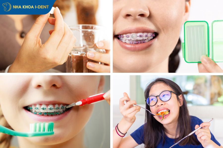 gắn khâu niềng răng